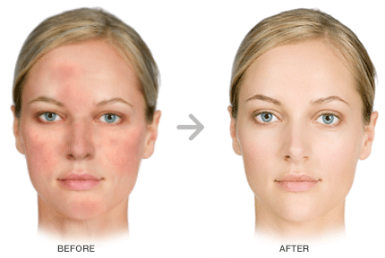 redspots rosacea